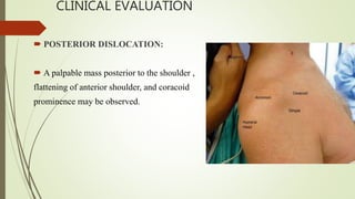 CLINICAL EVALUATION
 POSTERIOR DISLOCATION:
 A palpable mass posterior to the shoulder ,
flattening of anterior shoulder, and coracoid
prominence may be observed.
 