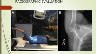 RADIOGRAPHIC EVALUATION
 
