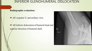 INFERIOR GLENOHUMERAL DISLOCATION
Radiographic evaluation:
 AP, scapular-Y, and axillary view.
 AP-inferior dislocation of humeral head and
superior direction of humeral shaft.
 