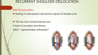 RECURRENT SHOULDER DISLOCATION
Putti-Platt procedure:
 Reefing of subscapularis and anterior capsule of shoulder joint.
 This has led to limited function and
A form of secondary joint disease
called “capsulorrhaphy arthropathy”
 