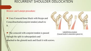 RECURRENT SHOULDER DISLOCATION
Bristow and Latarjet procedure:
 Uses Coracoid bone block with biceps and
Coracobrachialis(conjoint tendon) attach to
It.
 The coracoid with conjoint tendon is passed
through the split in subscapularis and
attached to the glenoid neck and fixed it with screws.
 