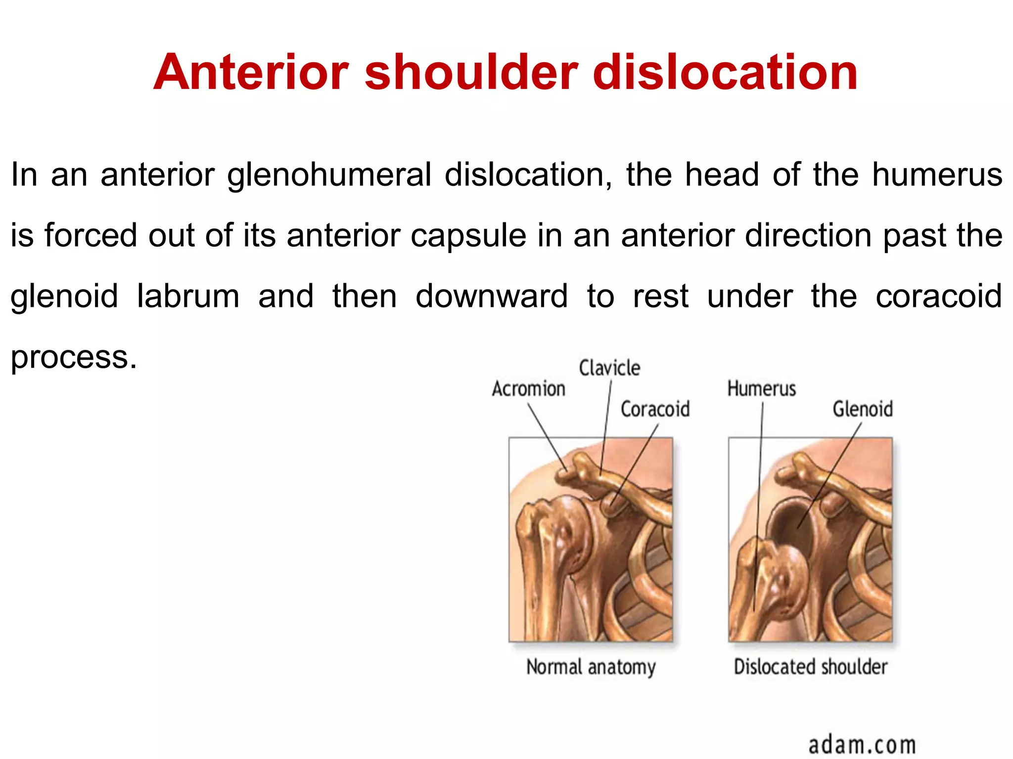 Anterior shoulder dislocation
In an anterior glenohumeral dislocation, the head of the humerus
is forced out of its anterior capsule in an anterior direction past the
glenoid labrum and then downward to rest under the coracoid
process.
 