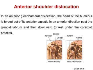 Anterior shoulder dislocation
In an anterior glenohumeral dislocation, the head of the humerus
is forced out of its anterior capsule in an anterior direction past the
glenoid labrum and then downward to rest under the coracoid
process.
 