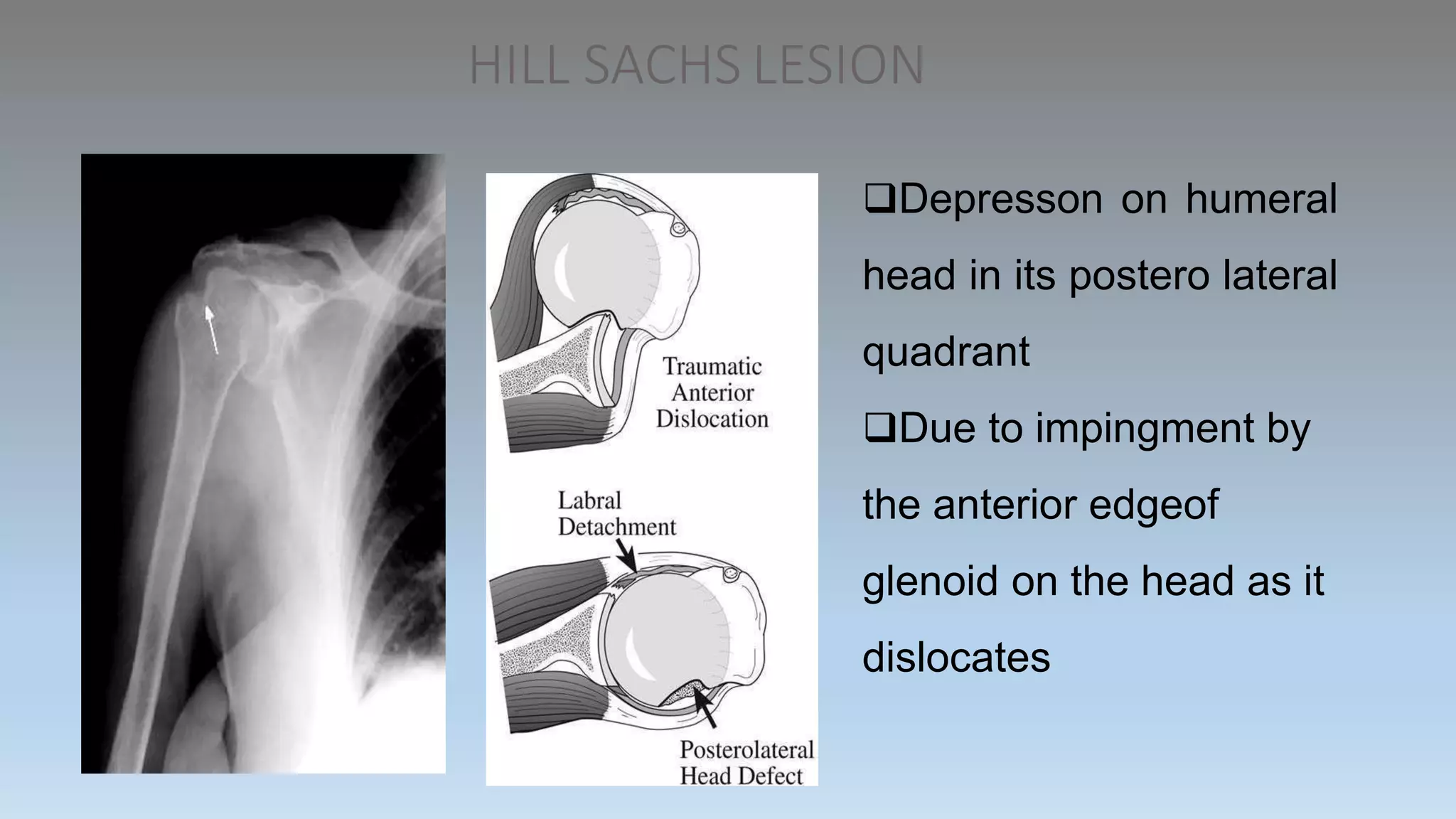HILL SACHS LESION
Depresson on humeral
head in its postero lateral
quadrant
Due to impingment by
the anterior edgeof
glenoid on the head as it
dislocates
 