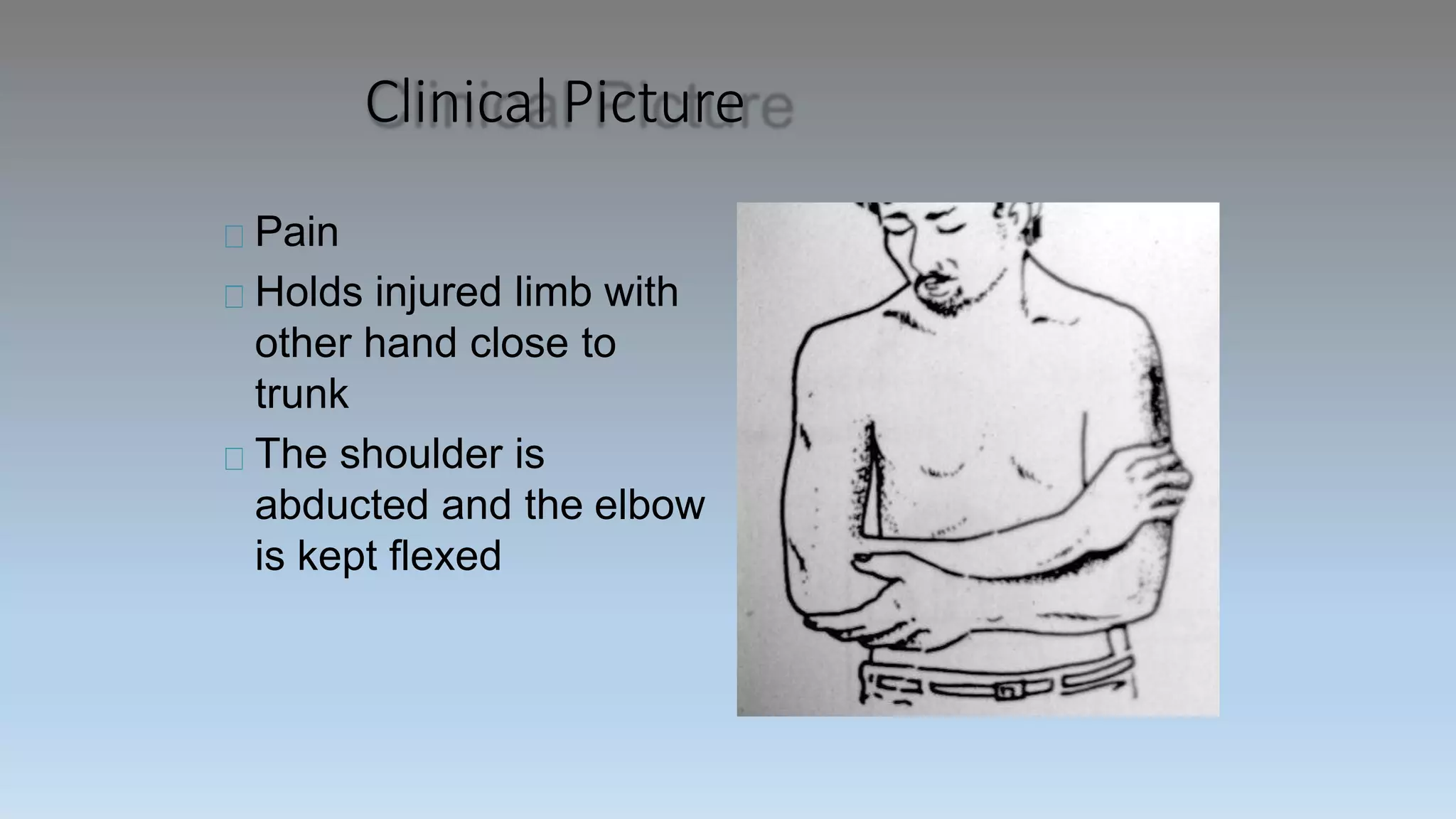Clinical Picture
Pain
Holds injured limb with
other hand close to
trunk
The shoulder is
abducted and the elbow
is kept flexed
 