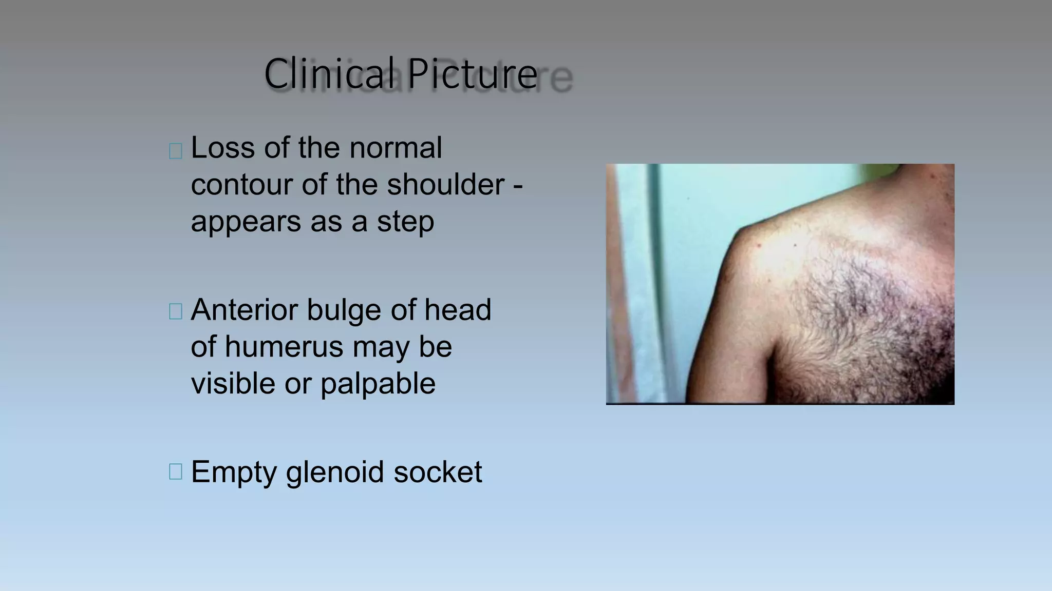 Clinical Picture
Loss of the normal
contour of the shoulder -
appears as a step
Anterior bulge of head
of humerus may be
visible or palpable
Empty glenoid socket
 