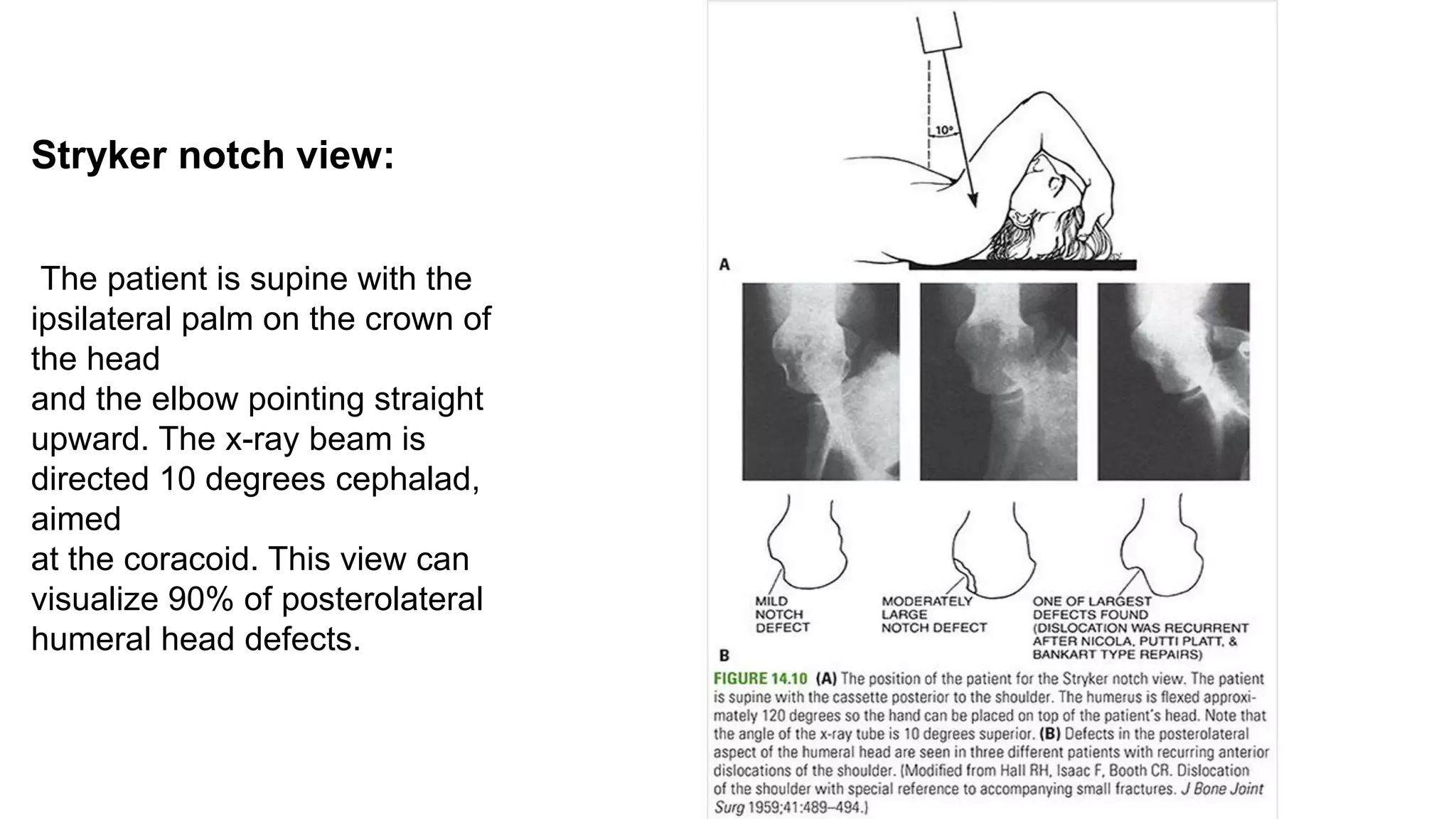 Stryker notch view:
The patient is supine with the
ipsilateral palm on the crown of
the head
and the elbow pointing straight
upward. The x-ray beam is
directed 10 degrees cephalad,
aimed
at the coracoid. This view can
visualize 90% of posterolateral
humeral head defects.
 