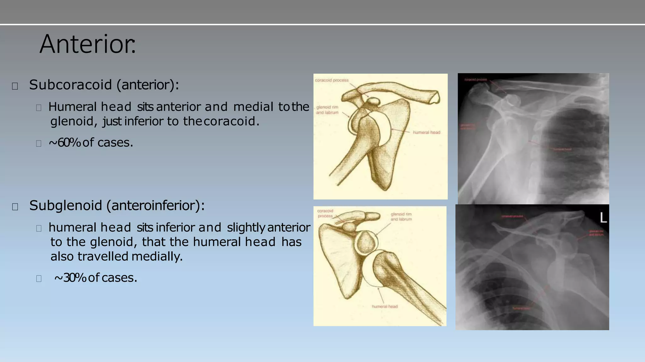 Anterior:
Subcoracoid (anterior):
Humeral head sits anterior and medial tothe
glenoid, just inferior to thecoracoid.
~60%of cases.
Subglenoid (anteroinferior):
humeral head sits inferior and slightlyanterior
to the glenoid, that the humeral head has
also travelled medially.
~30%of cases.
 