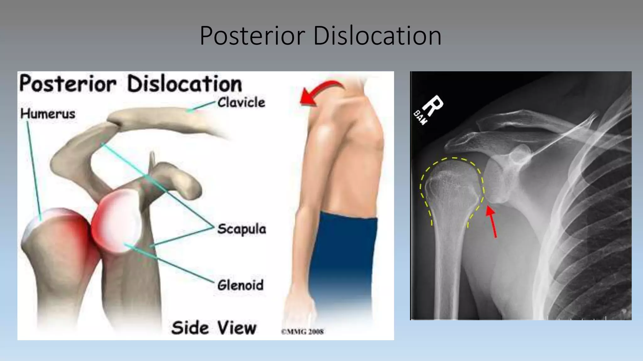 Posterior Dislocation
 