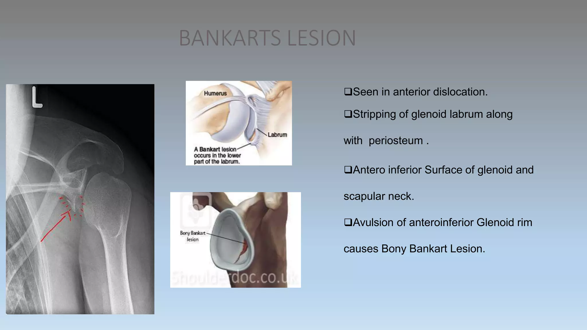 BANKARTS LESION
Seen in anterior dislocation.
Stripping of glenoid labrum along
with periosteum .
Antero inferior Surface of glenoid and
scapular neck.
Avulsion of anteroinferior Glenoid rim
causes Bony Bankart Lesion.
 