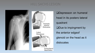 HILL SACHS LESION
Depresson on humeral
head in its postero lateral
quadrant
Due to impingment by
the anterior edgeof
glenoid on the head as it
dislocates
 