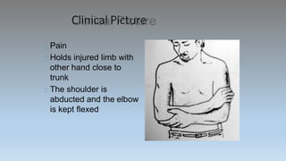 Clinical Picture
Pain
Holds injured limb with
other hand close to
trunk
The shoulder is
abducted and the elbow
is kept flexed
 