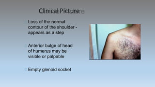 Clinical Picture
Loss of the normal
contour of the shoulder -
appears as a step
Anterior bulge of head
of humerus may be
visible or palpable
Empty glenoid socket
 