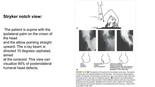 Stryker notch view:
The patient is supine with the
ipsilateral palm on the crown of
the head
and the elbow pointing straight
upward. The x-ray beam is
directed 10 degrees cephalad,
aimed
at the coracoid. This view can
visualize 90% of posterolateral
humeral head defects.
 