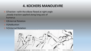 4. KOCHERS MANOUEVRE
I)Traction –with the elbow flexed at right angle
,steady traction applied along long axis of
humerus
II)External Rotation
III)Adduction
IV)Internal Rotation
 