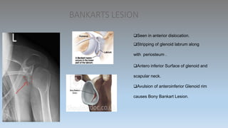 BANKARTS LESION
Seen in anterior dislocation.
Stripping of glenoid labrum along
with periosteum .
Antero inferior Surface of glenoid and
scapular neck.
Avulsion of anteroinferior Glenoid rim
causes Bony Bankart Lesion.
 