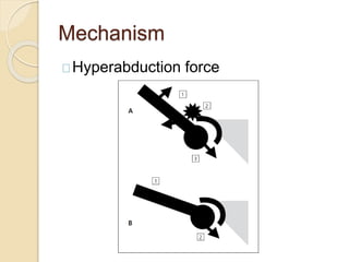 Mechanism
Hyperabduction force
 