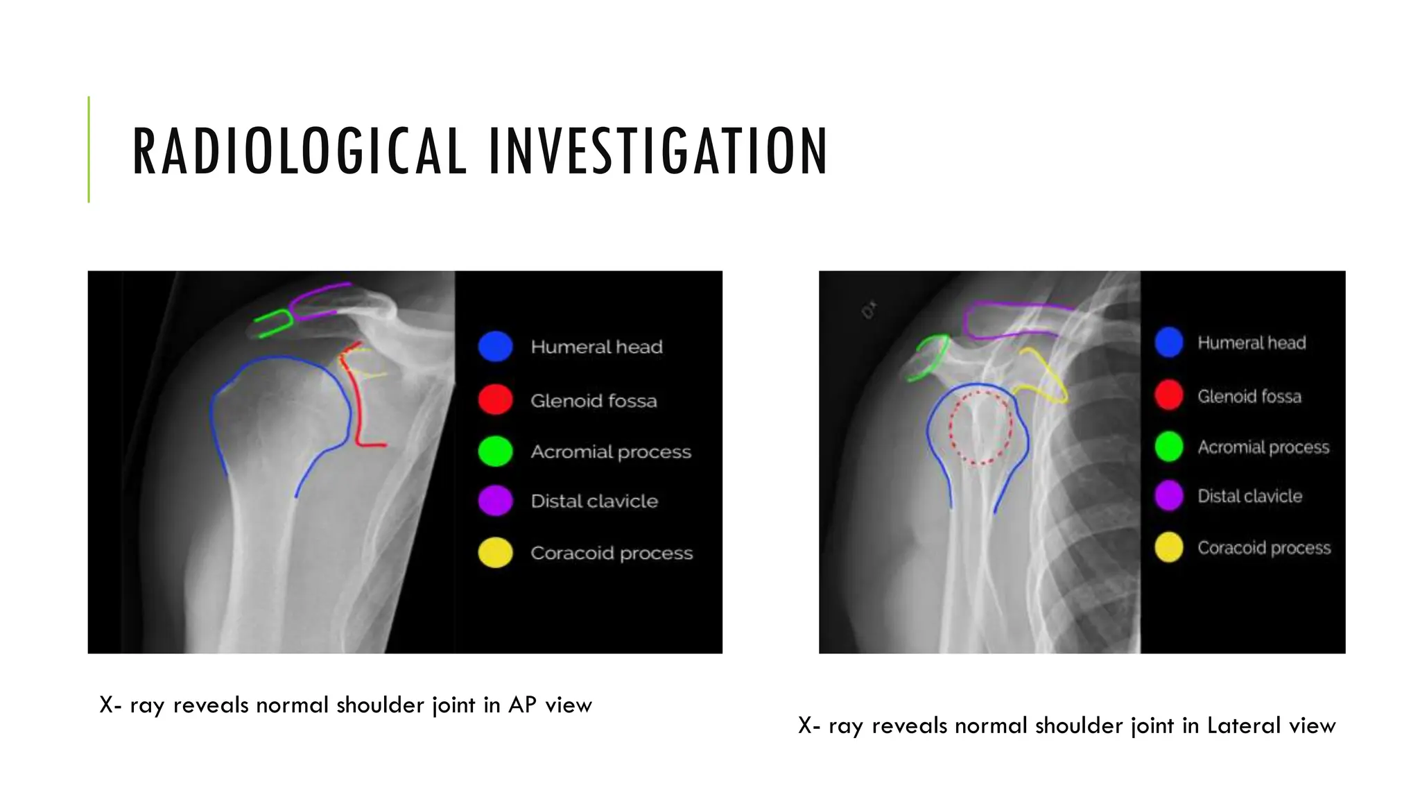 RADIOLOGICAL INVESTIGATION
X- ray reveals normal shoulder joint in AP view
X- ray reveals normal shoulder joint in Lateral view
 