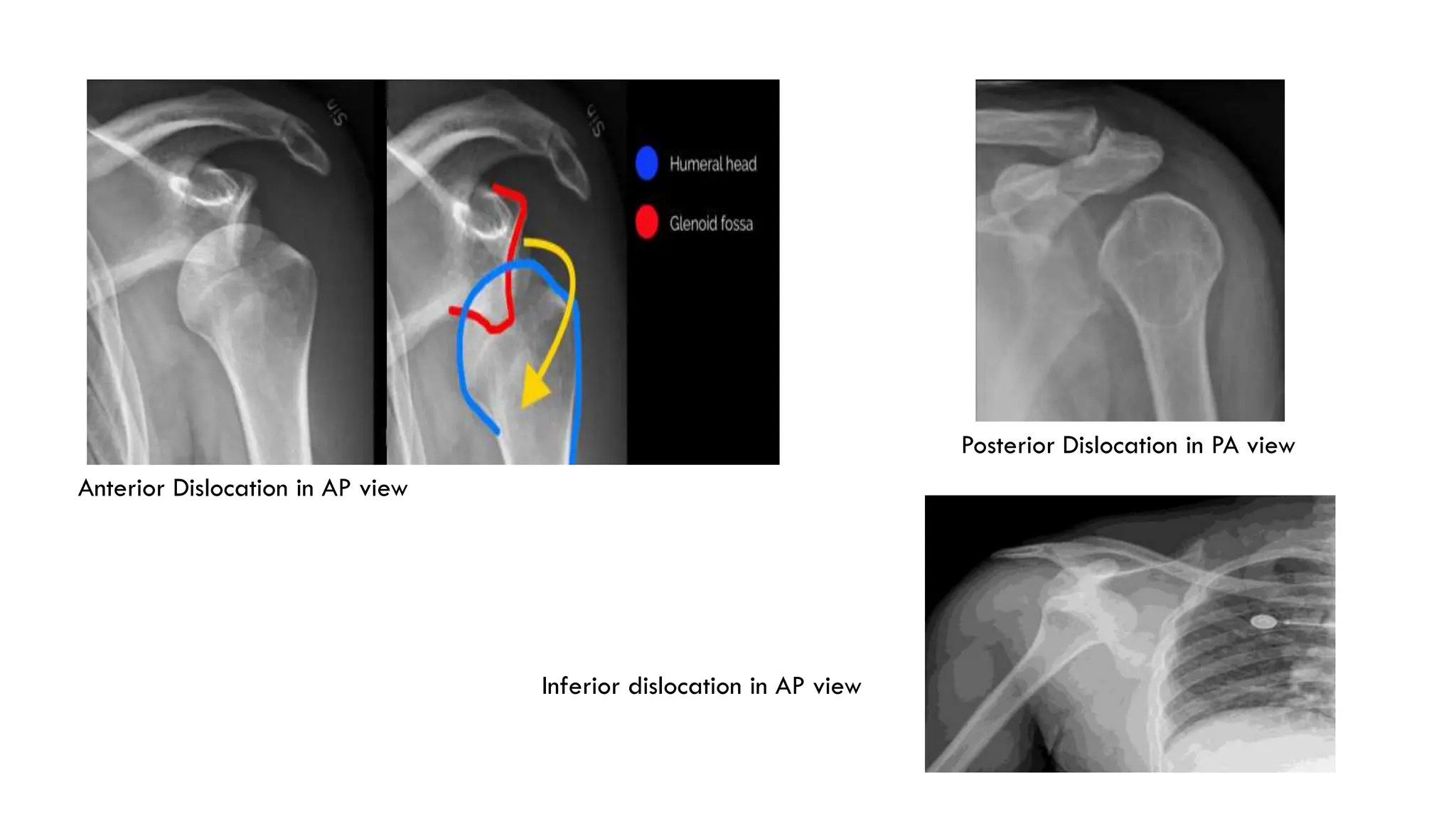 Anterior Dislocation in AP view
Posterior Dislocation in PA view
Inferior dislocation in AP view
 