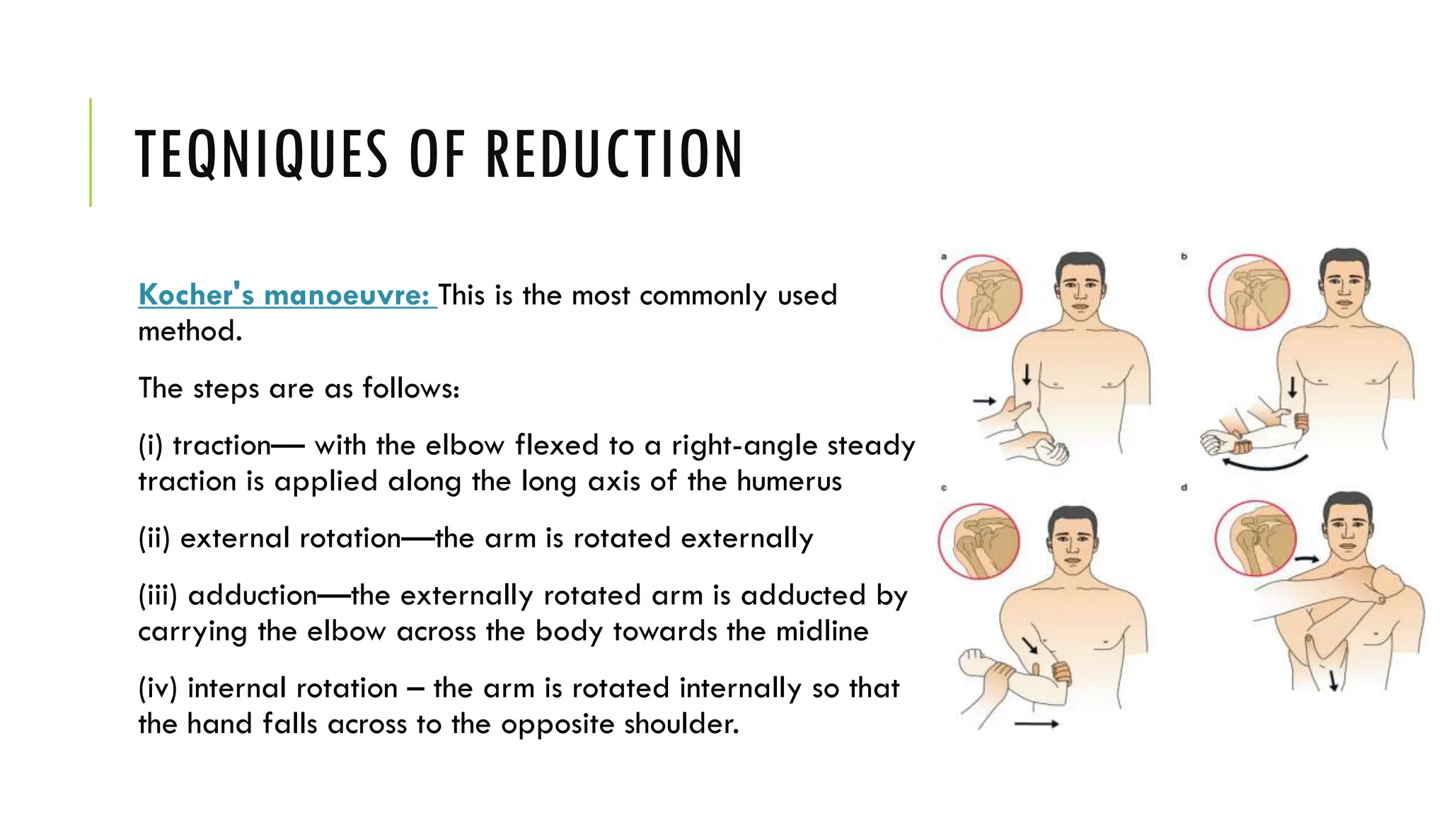 TEQNIQUES OF REDUCTION
Kocher's manoeuvre: This is the most commonly used
method.
The steps are as follows:
(i) traction— with the elbow flexed to a right-angle steady
traction is applied along the long axis of the humerus
(ii) external rotation—the arm is rotated externally
(iii) adduction—the externally rotated arm is adducted by
carrying the elbow across the body towards the midline
(iv) internal rotation – the arm is rotated internally so that
the hand falls across to the opposite shoulder.
 