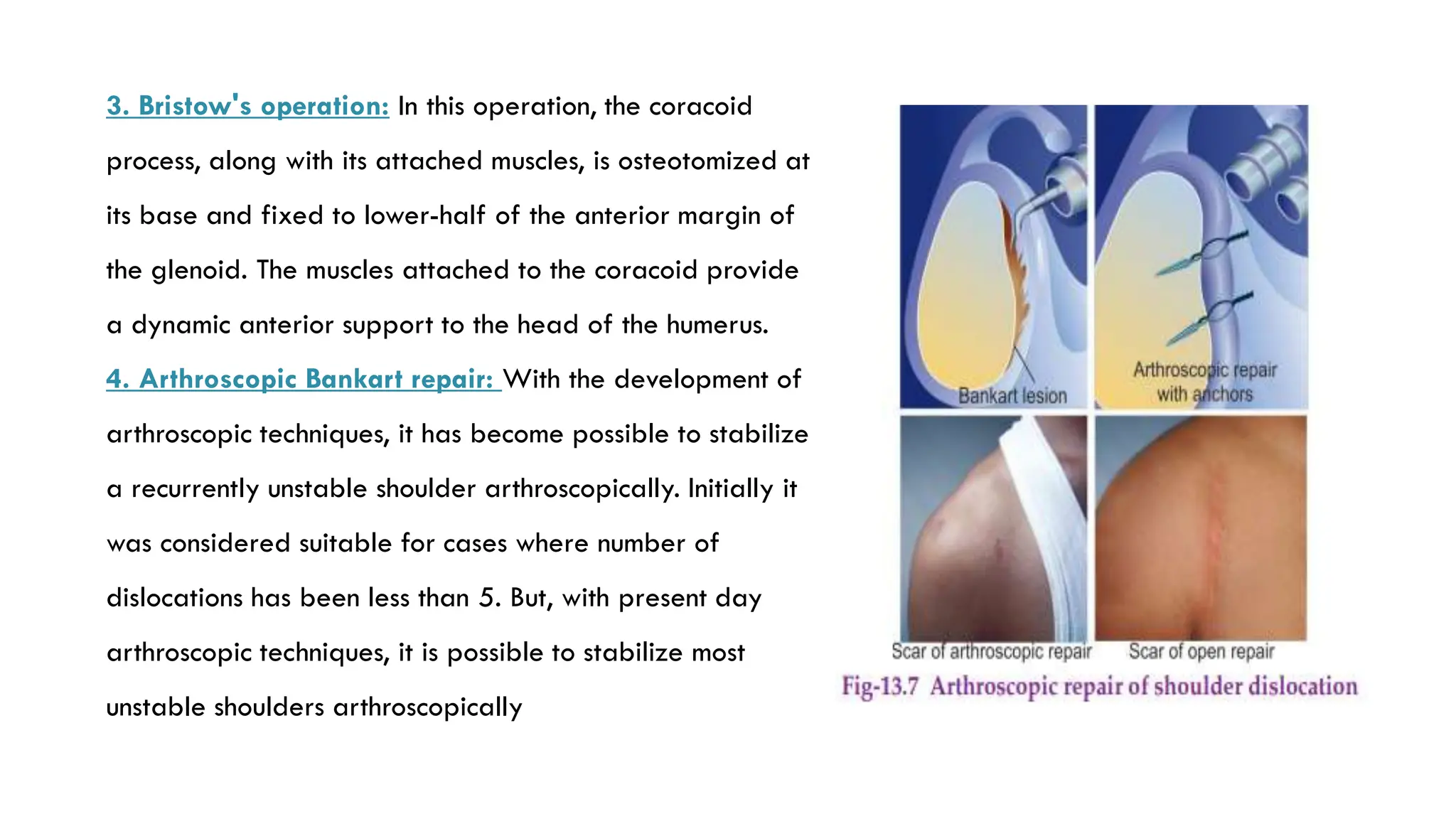 3. Bristow's operation: In this operation, the coracoid
process, along with its attached muscles, is osteotomized at
its base and fixed to lower-half of the anterior margin of
the glenoid. The muscles attached to the coracoid provide
a dynamic anterior support to the head of the humerus.
4. Arthroscopic Bankart repair: With the development of
arthroscopic techniques, it has become possible to stabilize
a recurrently unstable shoulder arthroscopically. Initially it
was considered suitable for cases where number of
dislocations has been less than 5. But, with present day
arthroscopic techniques, it is possible to stabilize most
unstable shoulders arthroscopically
 