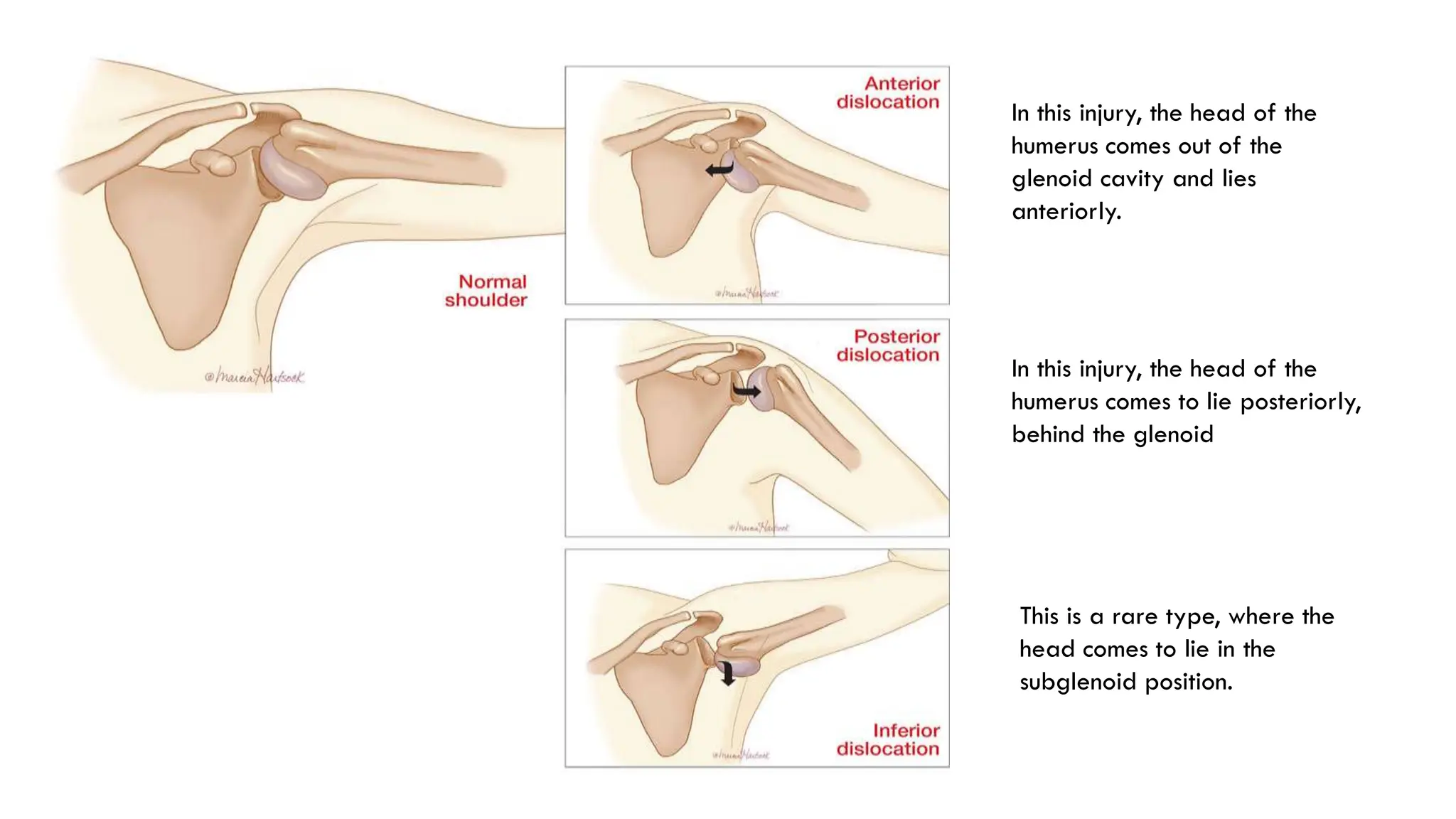 In this injury, the head of the
humerus comes out of the
glenoid cavity and lies
anteriorly.
In this injury, the head of the
humerus comes to lie posteriorly,
behind the glenoid
This is a rare type, where the
head comes to lie in the
subglenoid position.
 