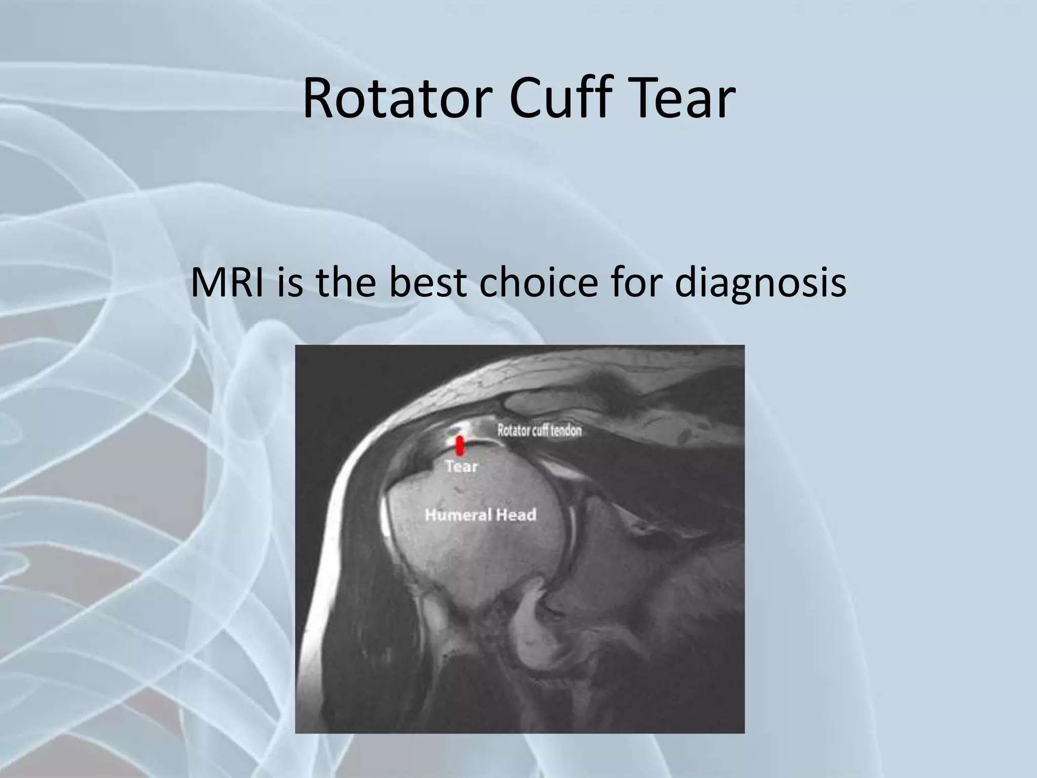 Rotator Cuff Tear
MRI is the best choice for diagnosis
 