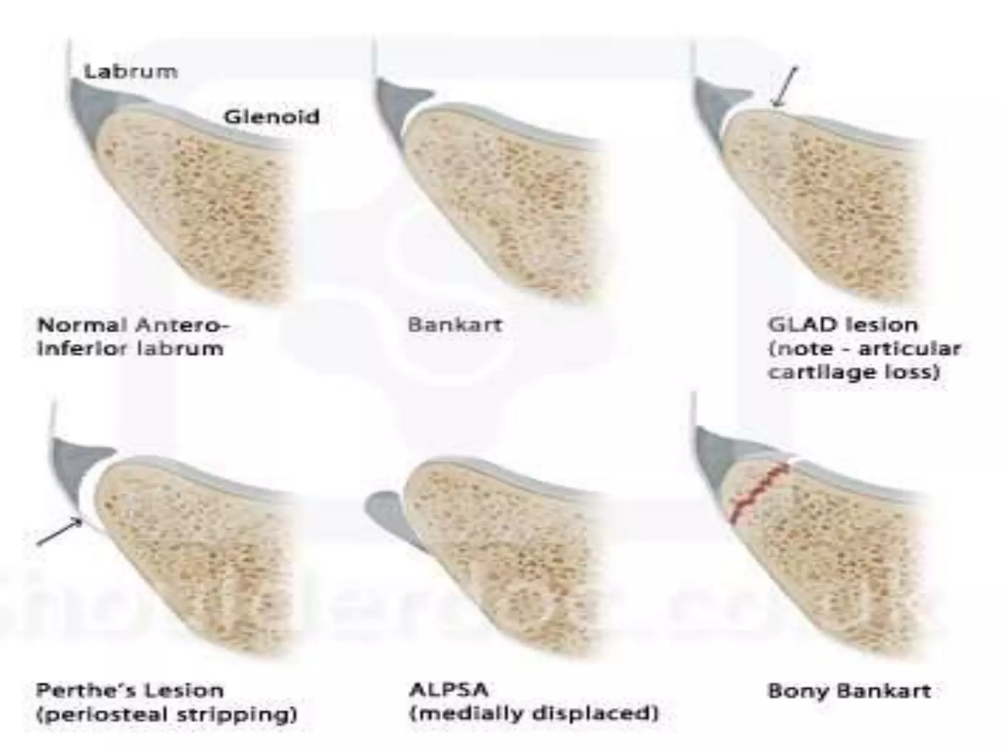 shoulder dislocationcation | PPT