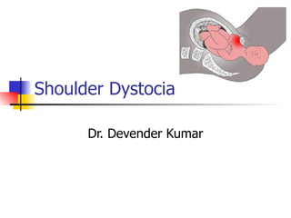 Shoulder Dystocia Dr. Devender Kumar 