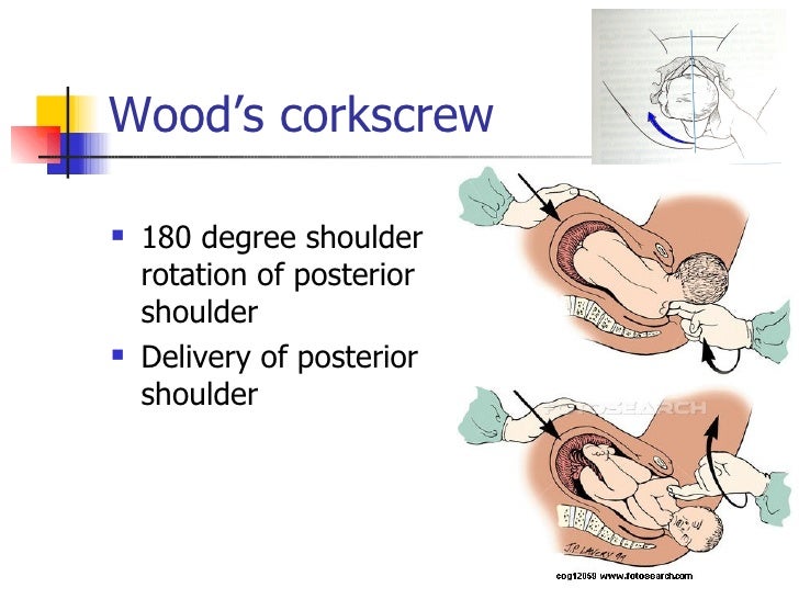 Shoulder Dystocia