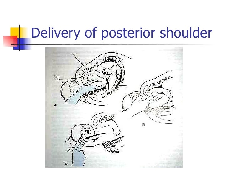 Shoulder Dystocia