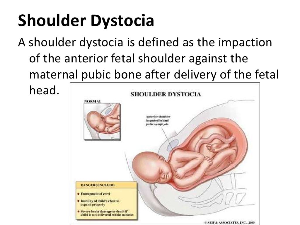 Shoulder dystocia
