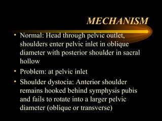MECHANISM Normal: Head through pelvic outlet, shoulders enter pelvic inlet in oblique diameter with posterior shoulder in sacral hollow Problem: at pelvic inlet Shoulder dystocia: Anterior shoulder remains hooked behind symphysis pubis and fails to rotate into a larger pelvic diameter (oblique or transverse) 