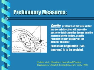 Preliminary Measures:

                      Gentle      pressure on the fetal vertex
                      in a dorsal di...