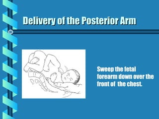 Delivery of the Posterior Arm



                  Sweep the fetal
                  forearm down over the
               ...