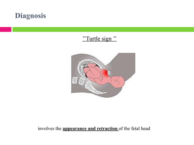 Shoulder dystocia / distocija fetlnih ramena | PPT