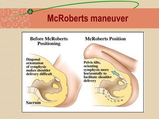 McRoberts maneuver
 