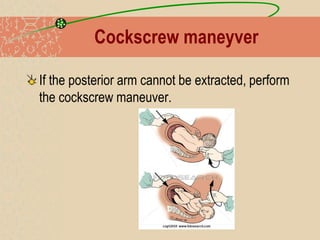 Cockscrew maneyver
If the posterior arm cannot be extracted, perform
the cockscrew maneuver.
 
