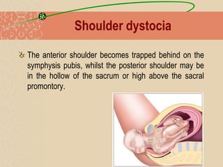 Shoulder dystocia
The anterior shoulder becomes trapped behind on the
symphysis pubis, whilst the posterior shoulder may be
in the hollow of the sacrum or high above the sacral
promontory.
 