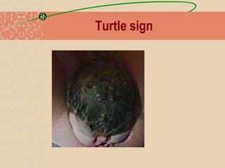 Shoulder dystocia | PPTX