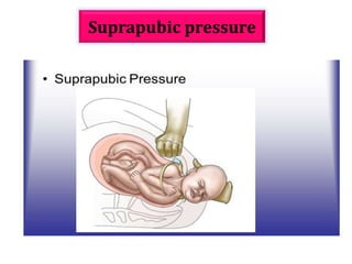 suprapubic-pressure