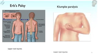 12
Erb's Palsy
Upper root injuries
Lower root injuries
Klumpke paralysis
 