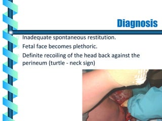 Diagnosis
Inadequate spontaneous restitution.
Fetal face becomes plethoric.
Definite recoiling of the head back against the
perineum (turtle - neck sign)
Ceska Gynekol 2010 ; 75(4):274-79
 