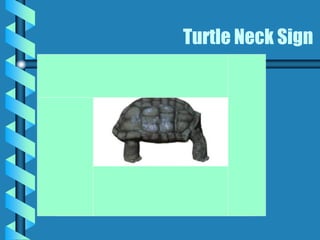 Turtle Neck Sign
 