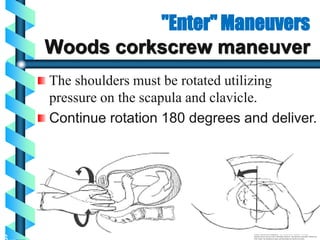 "Enter" Maneuvers
Woods corkscrew maneuver
The shoulders must be rotated utilizing
pressure on the scapula and clavicle.
Continue rotation 180 degrees and deliver.
1
.
2
.
 