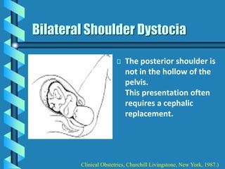 Bilateral Shoulder Dystocia
The posterior shoulder is
not in the hollow of the
pelvis.
This presentation often
requires a cephalic
replacement.
Clinical Obstetrics, Churchill Livingstone, New York, 1987.)
 