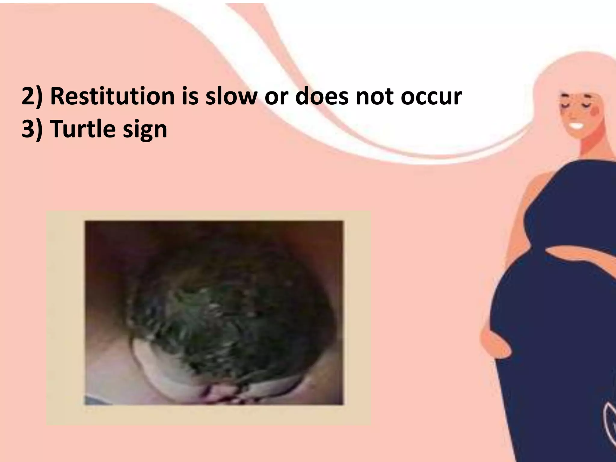 shoulder Dystocia.pptx