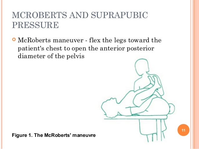 shoulder-dystocia