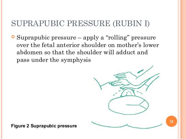 shoulder-dystocia