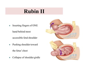 Shoulder dystocia 29.12.2020